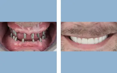 Before and After